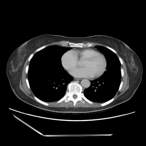 File:Bilateral adrenal granulocytic sarcomas (chloromas) (Radiopaedia 78375-91007 A 1).jpg