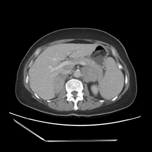 Bilateral adrenal granulocytic sarcomas (chloromas) (Radiopaedia 78375-91007 A 39).jpg
