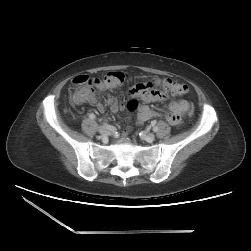 Bilateral adrenal granulocytic sarcomas (chloromas) (Radiopaedia 78375-91007 A 84).jpg