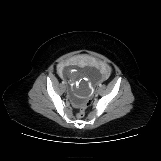 Bilateral adrenal thrombosis (Radiopaedia 58182-65256 A 64).jpg