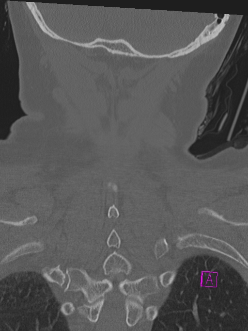 Bilateral atlanto-occipital assimilation (Radiopaedia 28350-28603 Coronal bone window 43).jpg