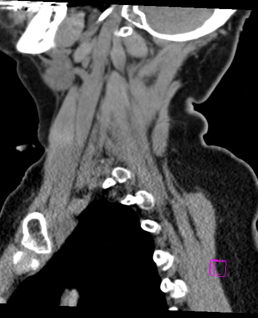 Bilateral atlanto-occipital assimilation (Radiopaedia 28350-28603 D 61).jpg