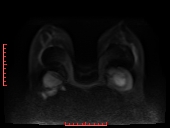 File:Bilateral breast implant rupture (Radiopaedia 24761-25027 DWI 18).jpg
