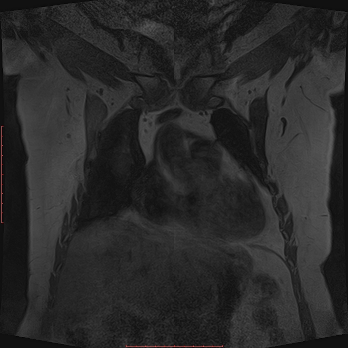 Bilateral breast implant rupture (Radiopaedia 24761-25027 G 5).jpg