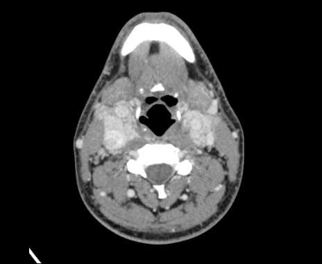Bilateral carotid body tumors (Radiopaedia 61841-69870 Axial Post contrast 53).jpg