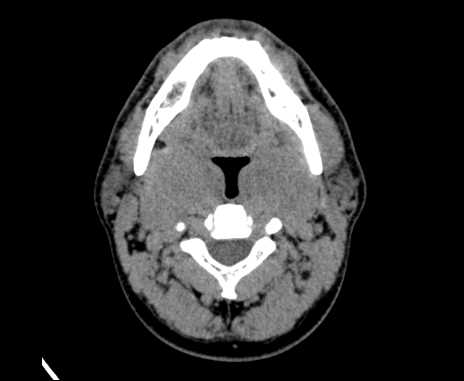 Bilateral carotid body tumors (Radiopaedia 61841-69870 Axial non-contrast 38).jpg