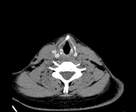 Bilateral carotid body tumors (Radiopaedia 61841-69870 Axial non-contrast 78).jpg