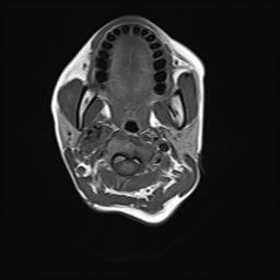 File:Bilateral carotid body tumors and right jugular paraganglioma (Radiopaedia 20024-20060 Axial 11).jpg