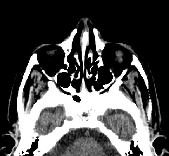 Bilateral ectopia lentis (Radiopaedia 89889-107013 Axial non-contrast 70).jpg
