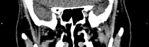 File:Bilateral enlargement of lacrimal glands - sarcoidosis (Radiopaedia 62627-70921 Coronal non-contrast 21).jpg