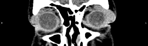 File:Bilateral enlargement of lacrimal glands - sarcoidosis (Radiopaedia 62627-70921 Coronal non-contrast 8).jpg