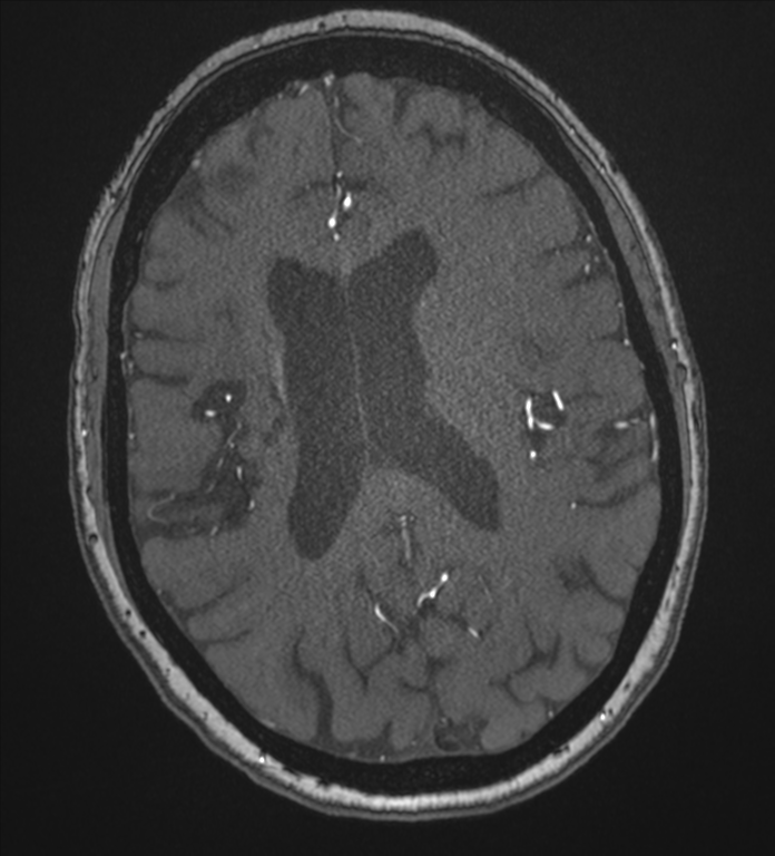 Bilateral fetal posterior communicating arteries (Radiopaedia 41286-44102 Axial MRA 137).png
