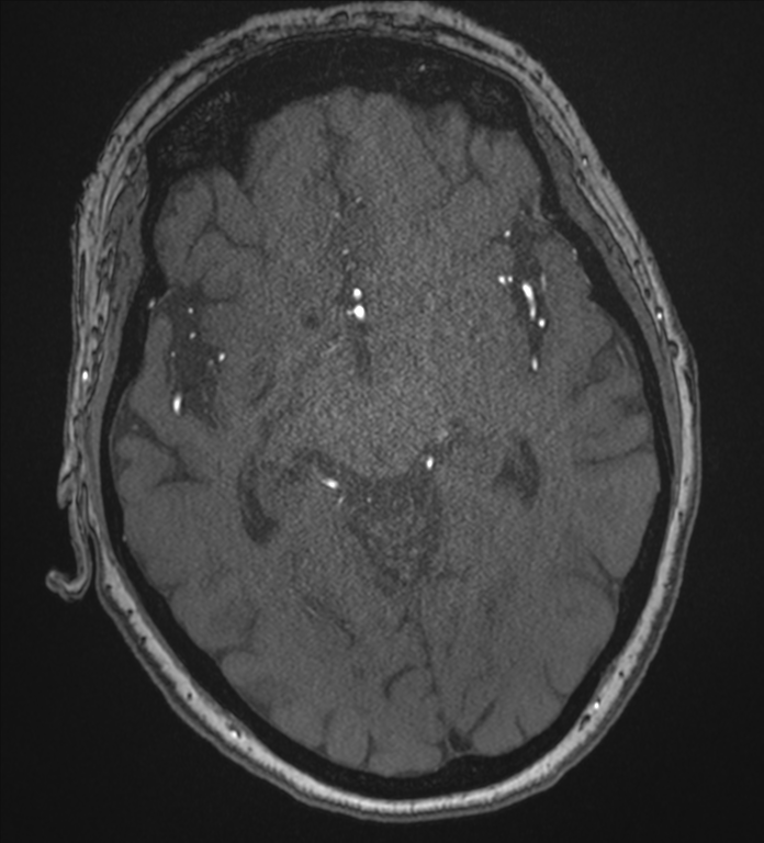 Bilateral fetal posterior communicating arteries (Radiopaedia 41286-44102 Axial MRA 96).png