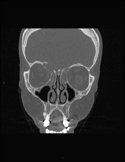 Bilateral frontal mucoceles (Radiopaedia 82352-96454 Coronal 121).jpg