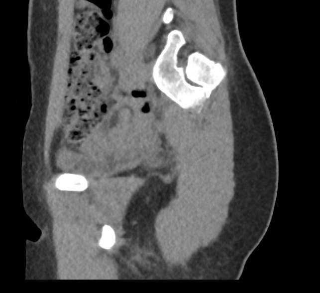 Bilateral mature cystic ovarian teratoma (Radiopaedia 88821-105592 D 11).jpg