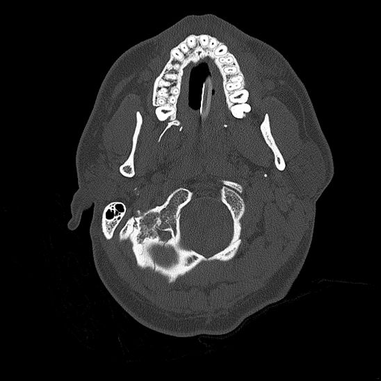 Bilateral occipital condyle fracture (type 2) (Radiopaedia 87675-104089 Axial bone thins 13).jpg
