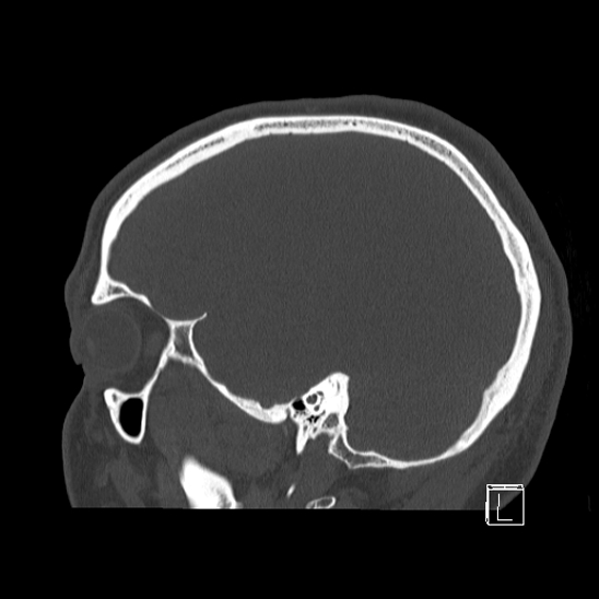 Bilateral occipital condyle fracture (type 2) (Radiopaedia 87675-104089 Sagittal bone window 20).jpg