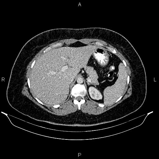 Bilateral ovarian dermoid cysts (Radiopaedia 85785-101603 A 29).jpg