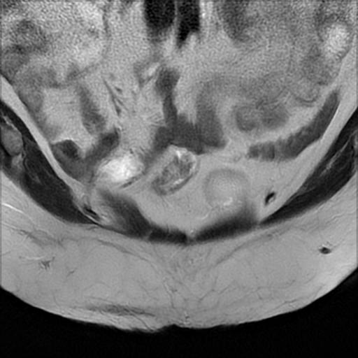 File:Bilateral ovarian dermoid cysts (Radiopaedia 90152-107338 Coronal T2 4).jpg