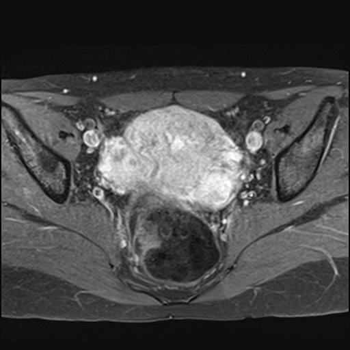File:Bilateral ovarian endometriomas (Radiopaedia 87085-103347 Axial T1 C+ fat sat 11).jpg