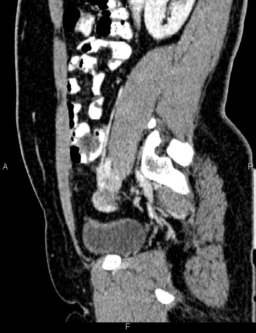 Bilateral ovarian teratoma (Radiopaedia 83131-97503 D 49).jpg