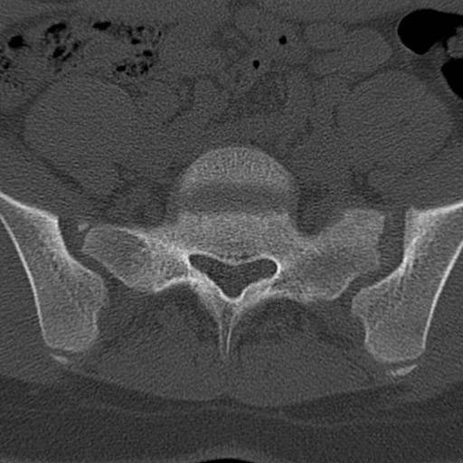 File:Bilateral pars defect (Radiopaedia 26691-26846 Axial bone window 74).jpg