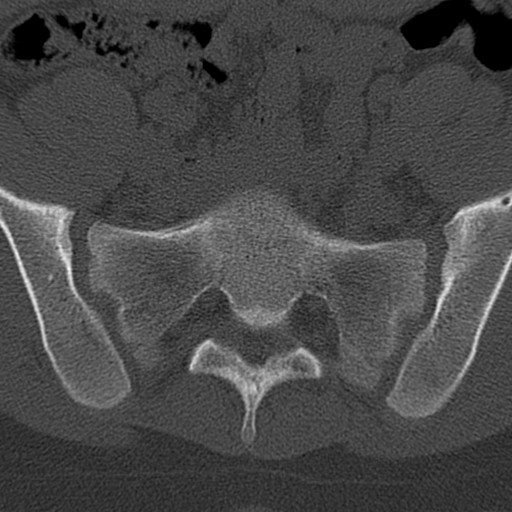 Bilateral pars defect (Radiopaedia 26691-26846 Axial bone window 88).jpg