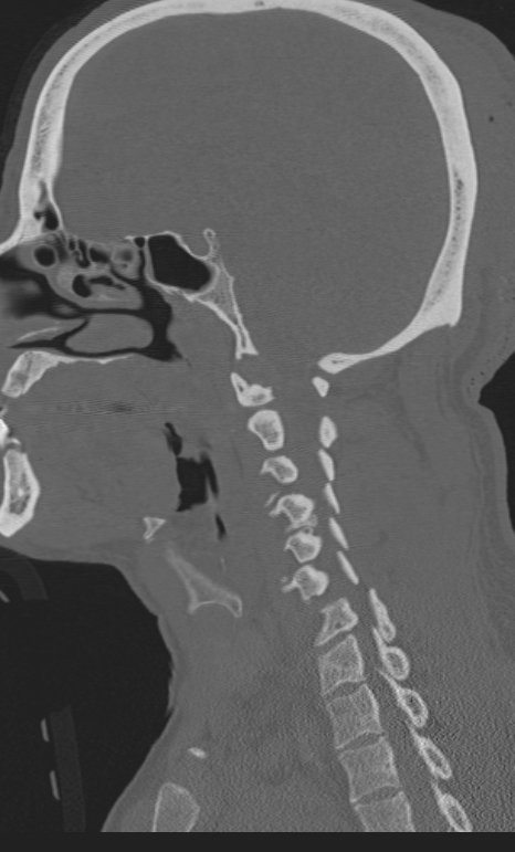 Bilateral perched facet joint (Radiopaedia 63149-71669 Sagittal bone window 16).jpg