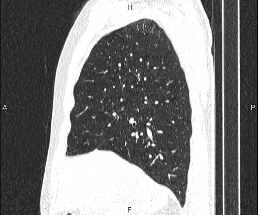 Bilateral pulmonary AVM (Radiopaedia 83134-97505 Sagittal lung window 40).jpg