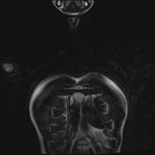 File:Bilateral spinoglenoid notch ganglion cysts (Radiopaedia 29577-30082 Coronal T2 4).jpg
