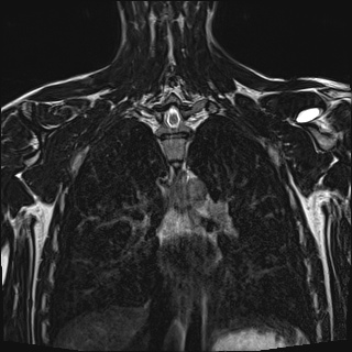 Bilateral spinoglenoid notch ganglion cysts (Radiopaedia 29577-30082 Coronal T2 82).jpg