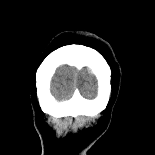 Bilateral subacute subdural hematoma (Radiopaedia 69240-79018 Coronal non-contrast 55).jpg