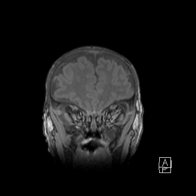 Bilateral subdural hemorrhage and parietal skull fracture (Radiopaedia 26058-26190 Coronal T1 11).png