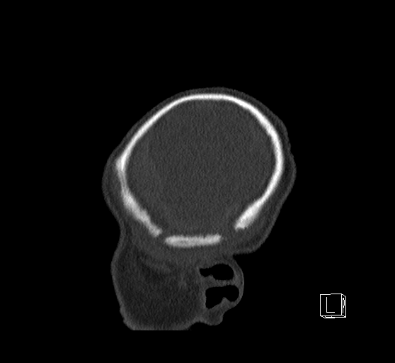 Bilateral subdural hemorrhage and parietal skull fracture (Radiopaedia 26058-26192 Sagittal bone window 8).png