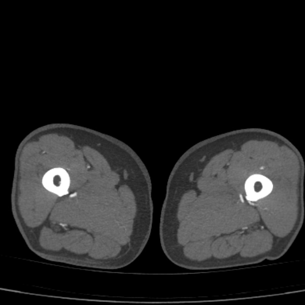 Bilateral superficial femoral arterial occlusion (Radiopaedia 25682-25857 A 40).jpg