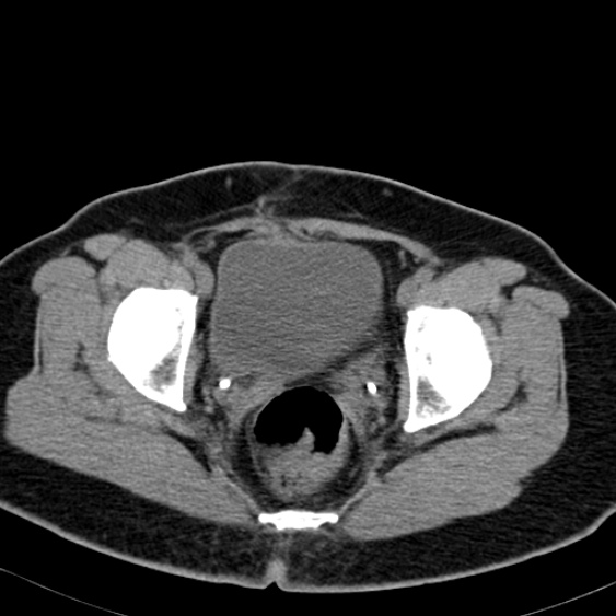 File:Bilateral ureteric stents (Radiopaedia 48795-53825 Axial non-contrast 61).jpg