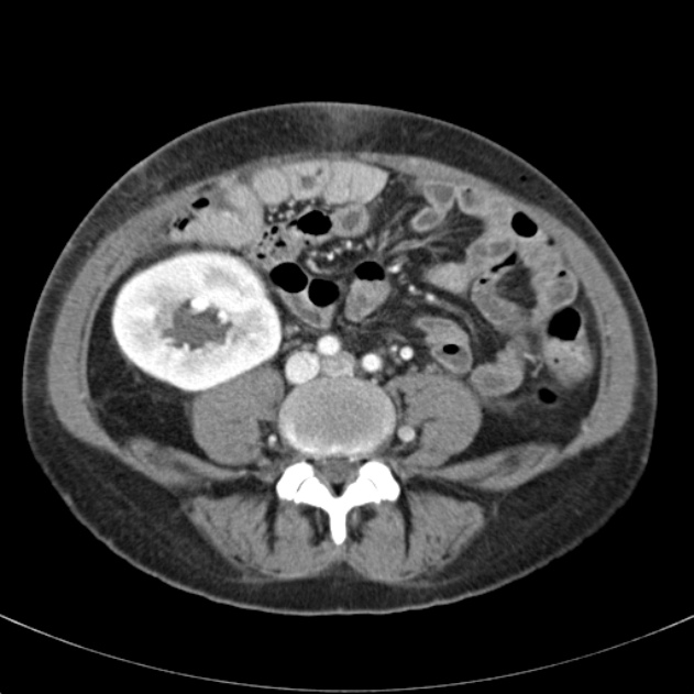 Biliary necrosis - liver transplant (Radiopaedia 21876-21846 B 49).jpg