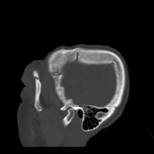 Biparietal osteodystrophy (Radiopaedia 46109-50463 Sagittal bone window 92).jpg