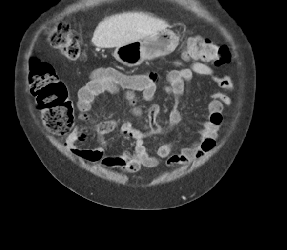 Bladder papillary urothelial carcinoma (Radiopaedia 48119-52951 C 15).png