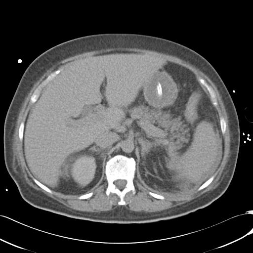 File:Bladder rupture post renal biopsy (Radiopaedia 30863-31572 Axial non-contrast 27).jpg