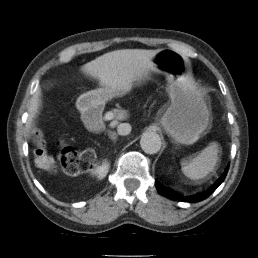 Bladder tumor detected on trauma CT (Radiopaedia 51809-57609 C 37).jpg