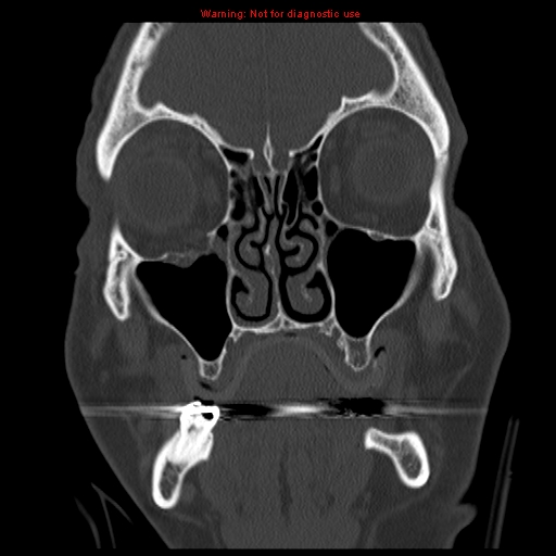 File:Blowout fracture with inferior rectus entrapment (Radiopaedia 12418-12673 Coronal bone window 5).jpg