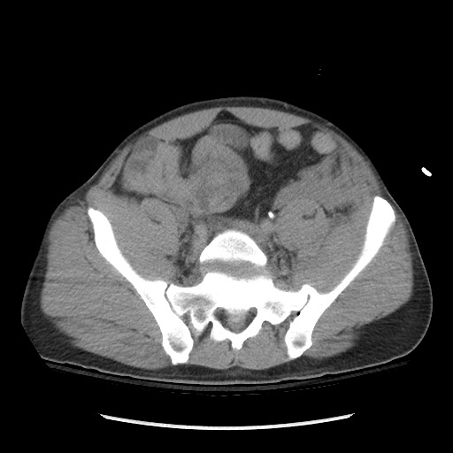 Blunt abdominal trauma with solid organ and musculoskelatal injury with active extravasation (Radiopaedia 68364-77895 Axial C+ delayed 105).jpg