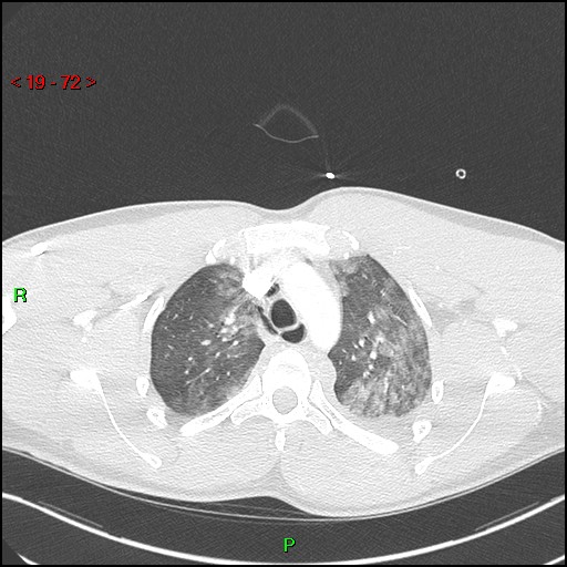 Blunt thoracic trauma (Radiopaedia 73454-84221 Axial lung window 26).jpg