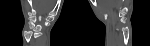 Bone islands - carpus (Radiopaedia 63141-71658 Coronal bone window 52).jpg