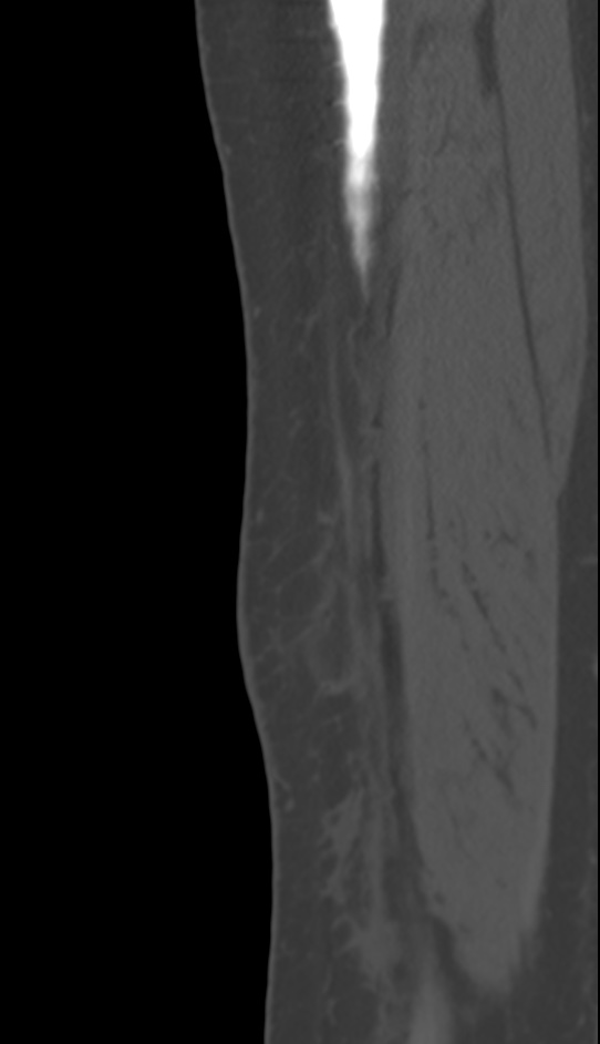 Bone metastasis - tibia (Radiopaedia 57665-64609 Sagittal bone window 28).jpg