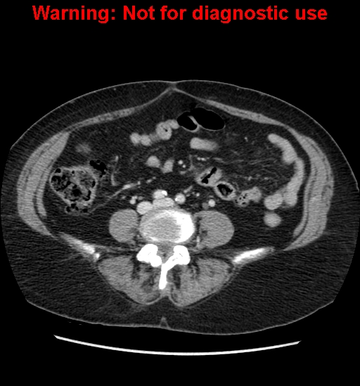 File:Bosniak renal cyst - type II (Radiopaedia 23404-23468 D 44).jpg