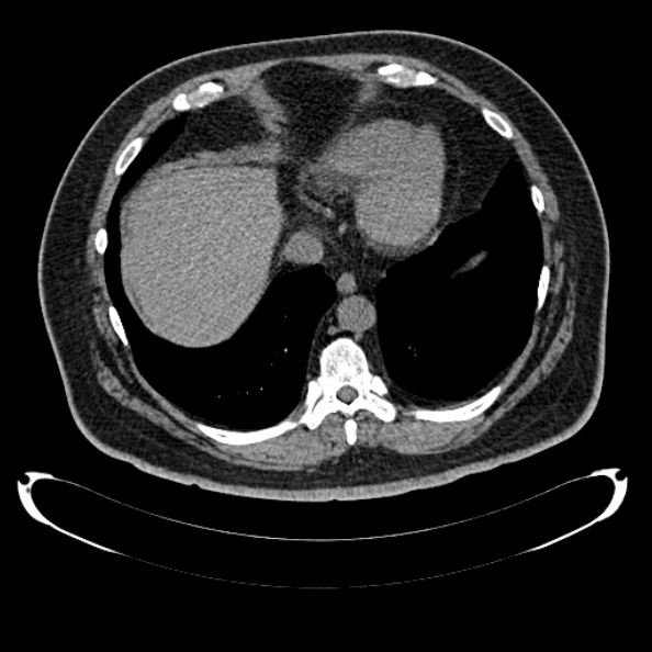 Bosniak renal cyst - type IV (Radiopaedia 24244-24518 Axial non-contrast 31).jpg