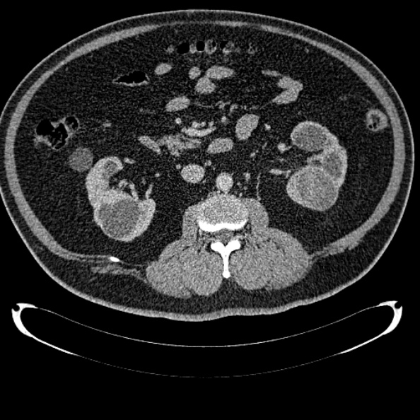 Bosniak renal cyst - type IV (Radiopaedia 24244-24518 C 168).jpg