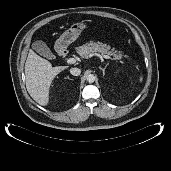 Bosniak renal cyst - type IV (Radiopaedia 24244-24518 C 97).jpg